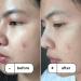 Buy Mangostin+ Intensive Formula with Tea Tree Oil - Breakout Vector Patch for Clear Skin | International Shipping - Buy Online on GoSupps.com