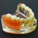 Dental Implant Restoration Model | Removable Bridge & Denture Demo for Teaching & Patient Education - Buy Online on GoSupps.com