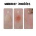 Bosuya Anti Itch Stick & Baimiss Bug Bite Relief Stick Set (6pcs) - Cool and Comfortable, Suitable for All Skin Types - Buy Online on GoSupps.com