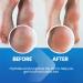Extra Strength Callus Remover for Feet - Professional Pedicure Grade Softener for Toes Heels & Hands - Buy Online on GoSupps.com