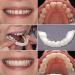 Instant Veneer Dentures Set - Serrated Top Bottom Fake Teeth for Men and Women - Buy Online on GoSupps.com