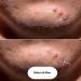 Shuvi Hydrocolloid Acne Blemish Patch - Vegan Cruelty-Free Treatment for Zits & Blemishes | 36 Count - All-Day/All-Night Adhesion - Buy Online on GoSupps.com