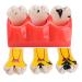 Dental Caries Teeth Model - 4 Times Removable Dental Tooth Decay Model Dental Caries Evolution Model Tooth Pathology Display Model