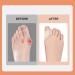 Elastic Hallux Valgus Belt - Soft Bunion Toe Stretcher & Alignment Corrector for Overlapping Toes - Skin Color (L) | International Shipping Available - Buy Online on GoSupps.com