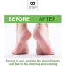 42% Urea Foot Cream - Urea Cream for Feet - Foot Cream for Dry Cracked Heels and Feet - Urea Cream with Salicylic Acid 2% Tea Tree Aloe Vera - Foot Lotion for Deep Moisturize for Thick Rough Skin - Buy Online on GoSupps.com