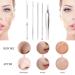 Stainless Steel Blackhead Remover Tool Kit with Metal Case - Acne & Blackhead Extractor Set in Silver Color - Buy Online on GoSupps.com
