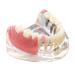 Dental Upper Implantate Model - Upper Overdenture Restoration Model - With superior teeth demo transparent vision soft gum implant nail for education and study model (D)