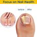 30ML Fungal nail repair fluid MYMULIKE toenail fungus repair extra strong nail repair solution for toenails and fingernails protects thick broken and discolored nails with - Buy Online on GoSupps.com