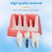Dental Implant Model - 4 Times Removable Crown Bridge | Educational Teeth Model for Learning & Analysis - Buy Online on GoSupps.com