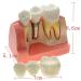 Samnuerly Dental Implant Model - 4-Way Analysis & Crown Bridge Demo for Training | International Shipping Available - Buy Online on GoSupps.com