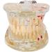 Dental Teeth Model for Parodontopathy Disease Transparent Removable Gingivae Pathology Teeth Model Used in Teaching Explain Studying for Adult - Buy Online on GoSupps.com