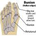 Bunion Corrector Set for Women and Men - Orthopedic Splint and Toe Separators for Pain Relief and Support - Hallux Valgus Treatment - 2Pcs - Buy Online on GoSupps.com