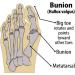 Bunion Corrector Orthopedic Splint for Big Toe Pain Relief 2Pack - Muekday Hallux Valgus Brace for Day/Night Support - Buy Online on GoSupps.com