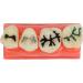 Ververt Touch Tooth Model - 180mm Dental Caries Demonstration Model for Schools & Dentists | Learning Aid for Dental Lessons - Buy Online on GoSupps.com