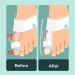 Bunion Corrector Set - Orthopedic Toe Straightener for Men and Women - Adjustable Splint with Toe Separator for Day and Night Relief (2 Pack) - Buy Online on GoSupps.com