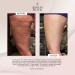 FasciaBlaster Trigger Point Tools by Ashley Black for Recovery & Anti-Cellulite - Skin Soothing Fascia Tool - Buy Online on GoSupps.com
