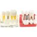 Implant Model Removable Bridge - Educational Teeth Model for Dental Studies | Perfect for Demonstration Classes - Buy Online on GoSupps.com