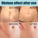 Stretch Mark Gel 2Pcs 50ml with Allantoin & Vitamin E - Hydrating Scar Remover for Scars, Burns & Surgery - Buy Online on GoSupps.com