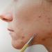 SC-11103-GLD Suvorna Whitehead Remover | Effective Pimple & Cyst Removal Tool for Clear Skin - Buy Online on GoSupps.com