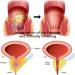 Heca Natural Herbal Strength Hemorrhoid Capsules Natural Hemorrhoid Relief Capsules Hemorrhoid Capsules 7pc/Box (2PCS) - Buy Online on GoSupps.com