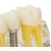Verdant Touch Dental Implant Model | Transparent Dental Implant for Teaching & Research | International Shipping - Buy Online on GoSupps.com