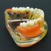 Dental Implant Restoration Model | Removable Bridge & Denture Demo for Teaching & Patient Education - Buy Online on GoSupps.com