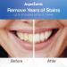 AquaSonic Power Bright Teeth Whitening Kit: Gel Syringes, LED Light, Whitening Pen - Fast & Safe Results - Buy Online on GoSupps.com
