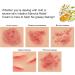 Manuka Honey Draw Salve Cream - Soothing Relief for Seborrheic Dermatitis Eczema Rosacea Psoriasis & Dry Scalp - Buy Online on GoSupps.com
