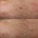 Deep Breakout Liquid Patch 15ml | Fast-Acting Acne Treatment | International Shipping Available - Buy Online on GoSupps.com