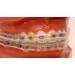 Orthodontic Quality Clear Comfort Cover Braces Guard - Mouth Protector for Braces - Snap On Strip - Buy Online on GoSupps.com