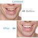 Temporary Tooth Repair Kit - 6PCS Fake Teeth Filling for Fixing Missing & Broken Tooth - Natural Shade - Buy Online on GoSupps.com