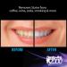 Denta-Pro2000 at Home Professional Teeth Whitening Kit - Safe, Affordable, & Effective for Whiter Teeth in One Use! - Buy Online on GoSupps.com