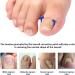 Toenail Patch Ingrown Toenail Toenail Correction Toenail Correction Patch Toenail Correction Patch Ingrown Toenail Nail Care 50 Pieces - Buy Online on GoSupps.com
