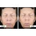 Buy Miracle Wrinkle Filler - 90 Second Results with Hyaluronic Acid for Youthful Skin | Fast International Shipping - Buy Online on GoSupps.com