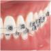 Orthodontic Teeth Model with Mental Brackets & Red Ligature - Tipodonto Dental Support for Treatment - Buy Online on GoSupps.com