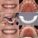 Buy Muyey Perfect Smile Teeth Veneers Set - Instant Comfort Fit & Whitening for a Flawless Smile | International Shipping Available - Buy Online on GoSupps.com