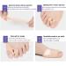 Icehao Toe Valgus Corrector & Bunion Straightener | Joint Pain Relief Aid | 24-Hour Painless Correction | 1 Pair | Complexion - Buy Online on GoSupps.com