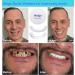 Brige Smile Temporary Teeth Denture | Enhance Your Smile Instantly - Buy Online on GoSupps.com
