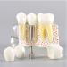 Dental Model Dentist Dental implant Model Resin Material Removable Used for Dental Clinic Research and Doctor-Patient Communication - Buy Online on GoSupps.com