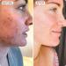 SONYA DAKAR Super Clear Serum - Acne Fighting with Salicylic Acid & Niacinamide | Minimize Pores Reduce Inflammation & Blemishes | International Shipping Available - Buy Online on GoSupps.com