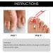 Ingrown Toenail Treatment Oil - Natural Drop for Cuticle Care & Fungal Nail Correction - 10ml (1Pcs) - Buy Online on GoSupps.com