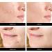 ACNE Patches - Miracle Hydrocolloid Spot Treatment for Blemishes & Breakouts | GO Acne GO - Fast Shipping Worldwide - Buy Online on GoSupps.com