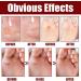 Extra Strong Foot Corn Remover Gel - 1pcs | GFOUK Pro Liquid Treatment - Buy Online on GoSupps.com