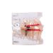 Easyinsmile Dental Orthodontic Treatment Model with Braces - Metal & Ceramic - Buy Online on GoSupps.com