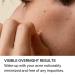 Y OUR Healing Acne Patches - Hydrocolloid Bandages for Pimple & Blackhead Removal | Effective Overnight Treatment Dots for Blemishes & Zits - Clear Skin Solution - Buy Online on GoSupps.com