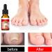 Nail and Toenail Strengthening Liquid 10ml Ingrown Toenail Corrector Drops Beauty Care for Hands and Feet Nighttime Travel-Friendly - Buy Online on GoSupps.com