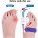 Yipoch Big Toe Bunion Straightener - Hallux Valgus Corrector & Bunion Splint for Unisex Foot Care | Shop Now for Pain Relief - Buy Online on GoSupps.com