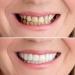 Buy Temporary Fake Teeth for Men & Women | Comfortable Cosmetic Denture Veneers for Upper & Lower Jaw - Regain Your Confident Smile - Buy Online on GoSupps.com