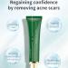 acne removal cream Acne Scar Removal Gel Face Body Marks Skin Repair Cream Acne Treatment Essence 30g - Buy Online on GoSupps.com
