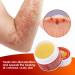 FIONEL 5pcs SkinMedix Psoriasis Herbal Cream - Natural Chinese Anti-Itch Ointment for Face & Body - Buy Online on GoSupps.com